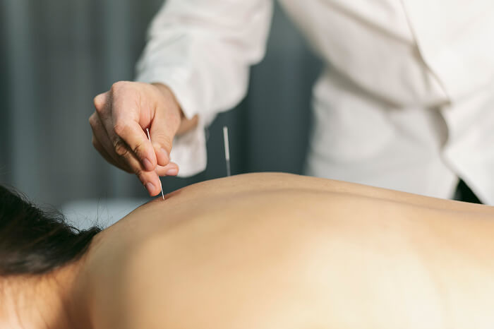 Licensed physical therapist performing dry needling therapy on a patient at Flexify Physical Therapy in Allen, TX to relieve muscle pain and improve flexibility.